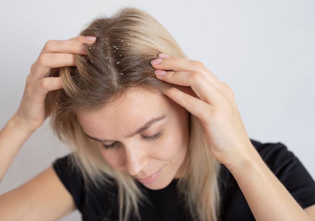 Discover The Best Dandruff Treatments To Banish Flakiness