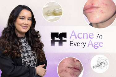 acne at every age story
