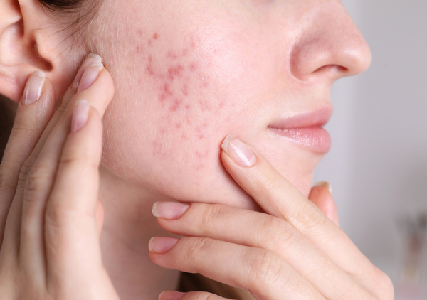 Woman inspecting acne scars