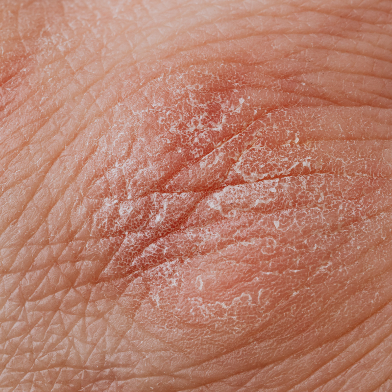 What is eczema