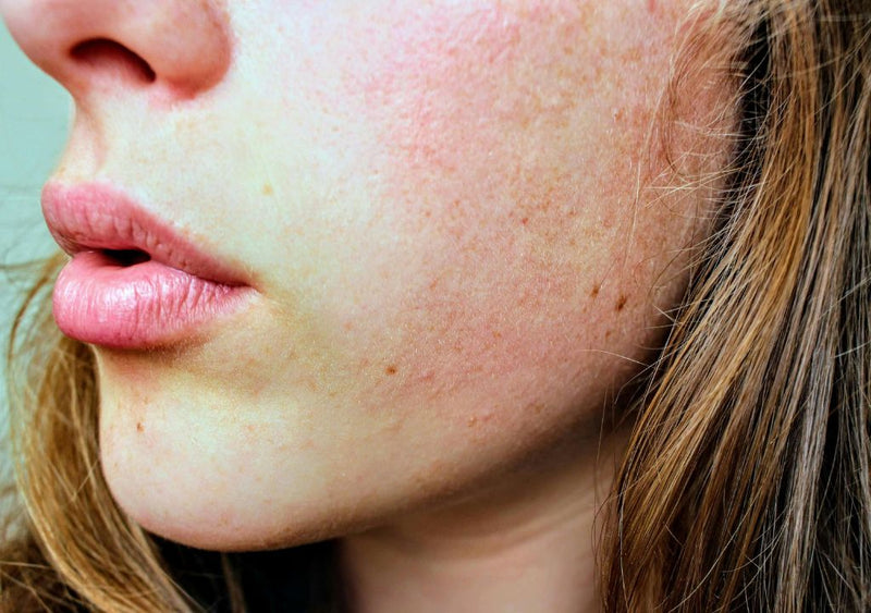 lady with dry winter-damaged skin