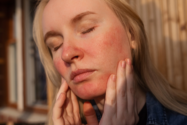 How to Treat Rosacea: Tips & Treatments