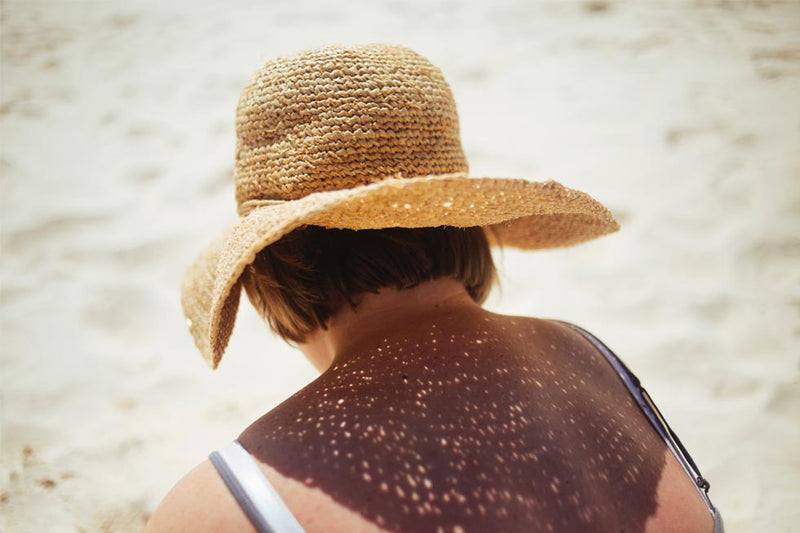 How To Avoid, Treat and Heal Sunburn