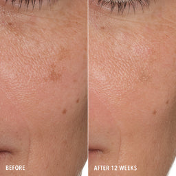 HydroPeptide Syner-C Before & After Tone & Texture