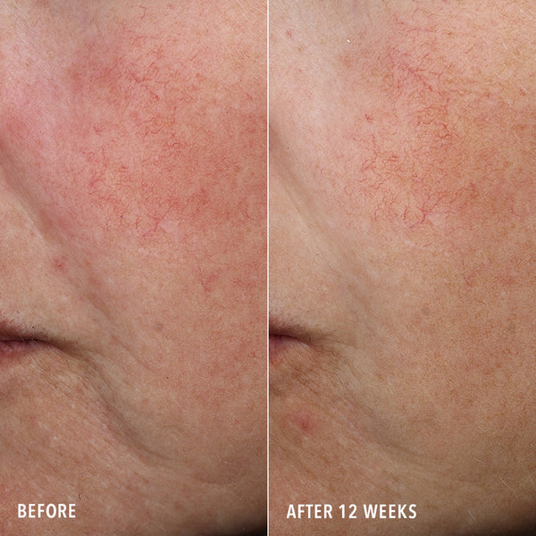 HydroPeptide Syner-C Before & After Redness