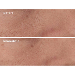 Murad Targeted Pore Corrector