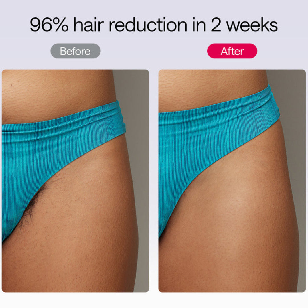 Before and after comparison of hair reduction on a person wearing blue underwear.