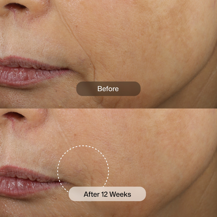 Before-and-after comparison of a person's lower face showing skin improvement over 12 weeks, with the top panel labeled 'Before' and the bottom panel labeled 'After 12 Weeks'.