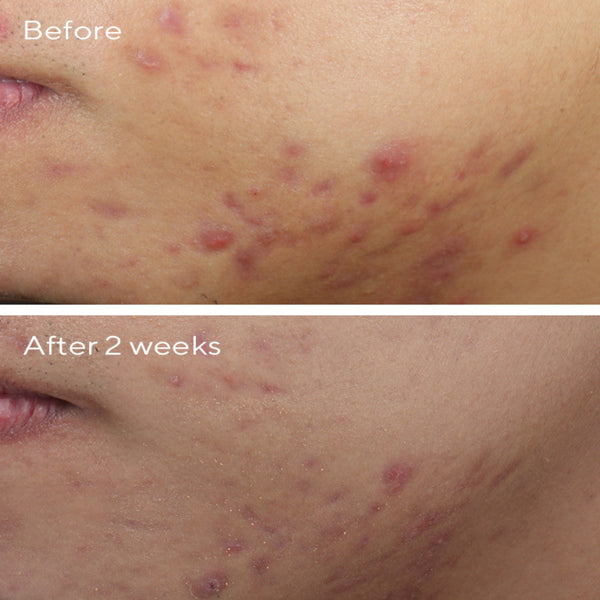 Murad Deep Relief Blemish Treatment