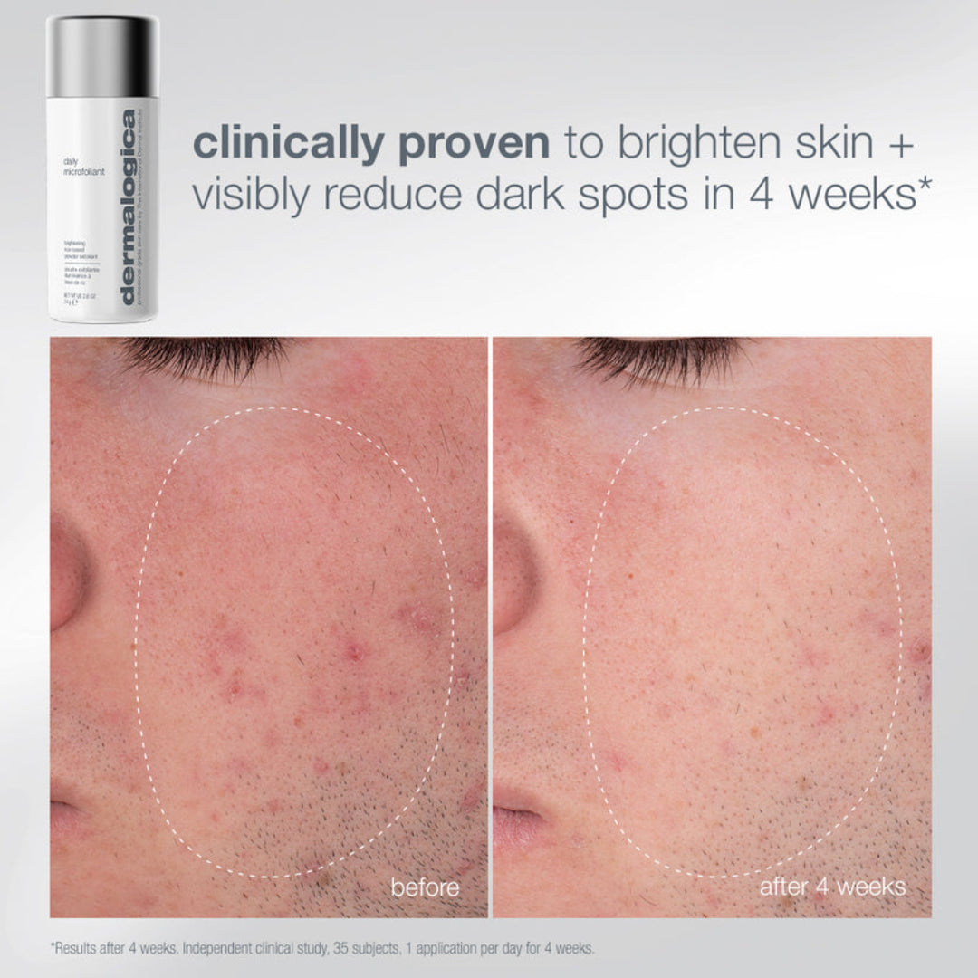 Dermalogica Skin Injector acne treatment bottle shown above a before-and-after comparison of facial skin texture and dark spots on the nose area, with marketing text stating clinically proven to brighten skin and reduce dark spots in 4 weeks.