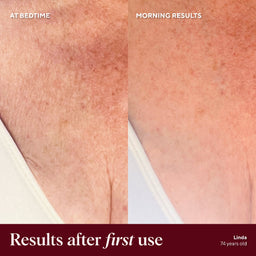 Before and after comparison of skin texture on a person's shoulder, labeled 'At Bedtime' and 'Morning Results'.