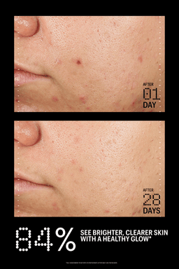 Before-and-after skincare comparison showing a close-up of a person's cheek with acne and red bumps, labeled 'AFTER 01 DAY' on top and 'AFTER 28 DAYS' on bottom, with large text at the bottom reading '84% SEE BRIGHTER, CLEARER SKIN WITH A HEALTHY GLOW'.