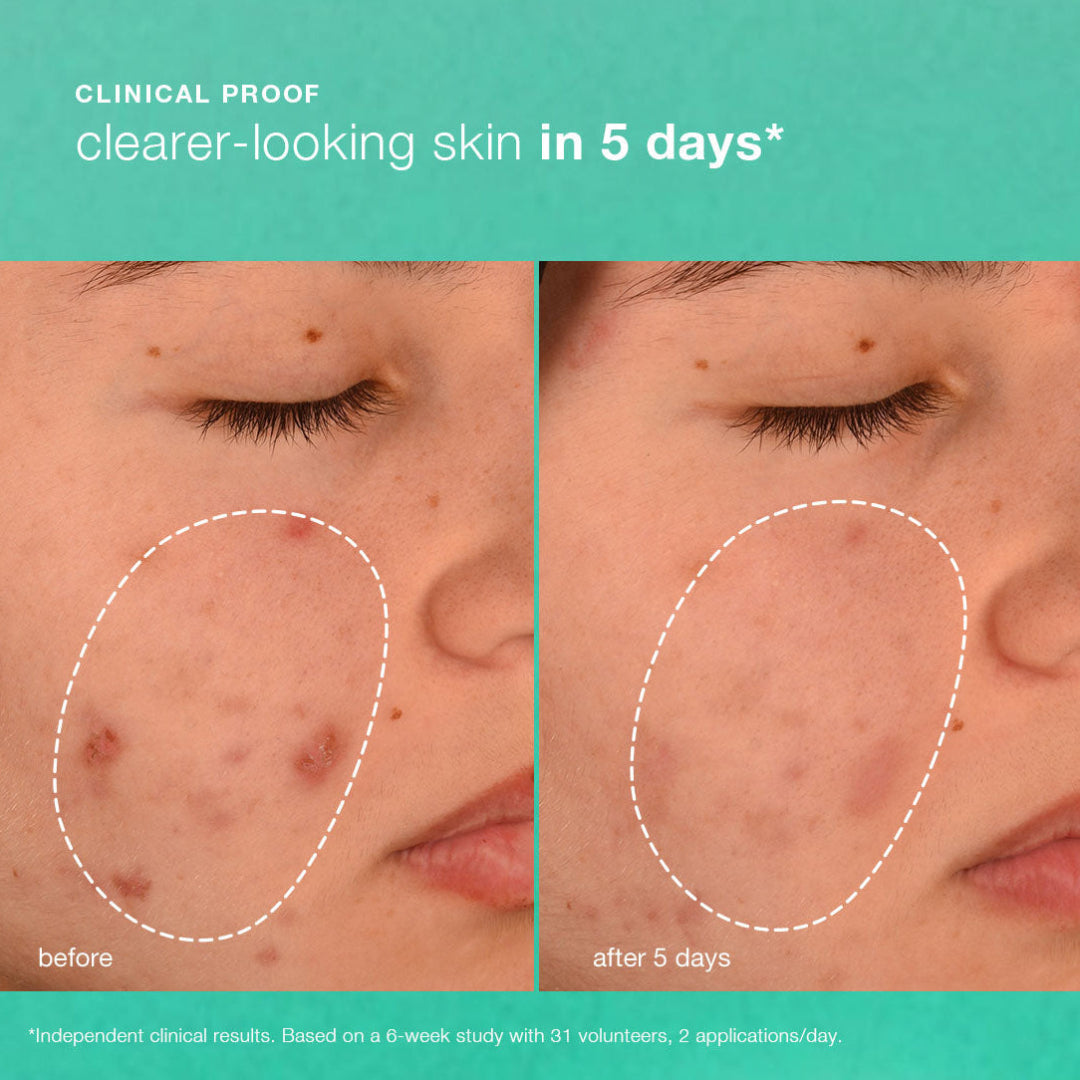 Before and after comparison of skin treatment showing clearer-looking skin in 5 days.