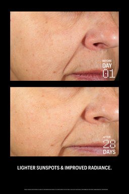 Before and after comparison of skin with sunspots and improved radiance on a black background.