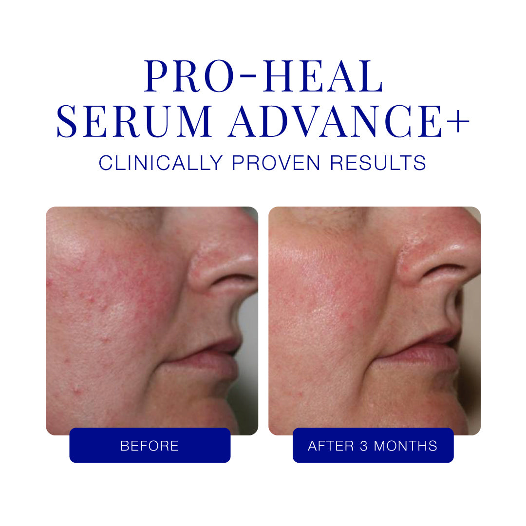 Before and after comparison of skin treatment with Pro-Heal Serum Advance+ on a person's face.
