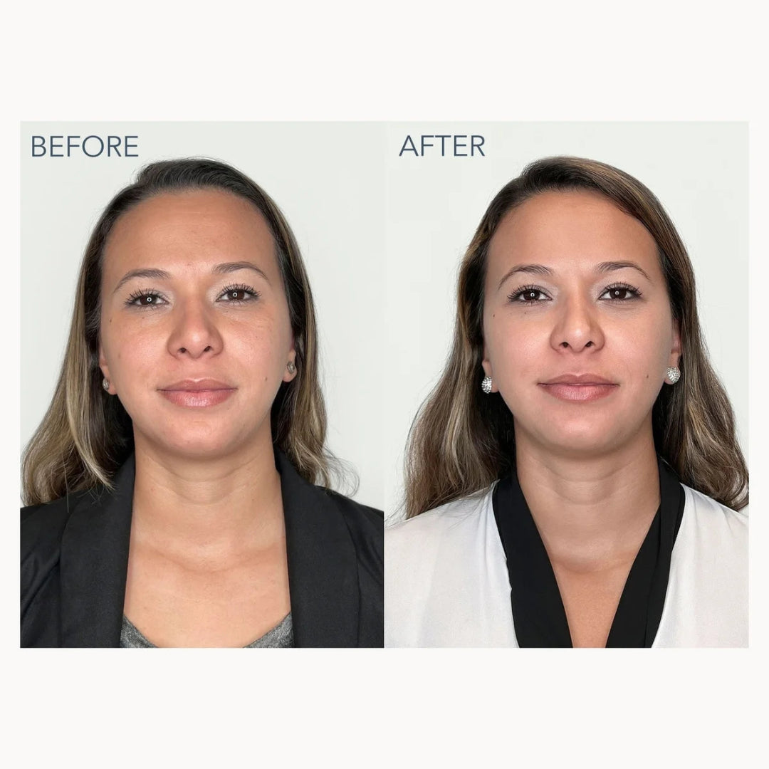Before and after comparison portrait of a woman, showing her face and upper torso against a plain light background. The left side is labeled BEFORE and shows a dark blazer; the right side is labeled AFTER and shows a white top with a black collar.